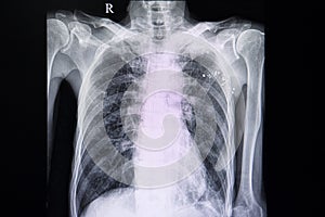 chest xray of a patient with pulmonary emphysema