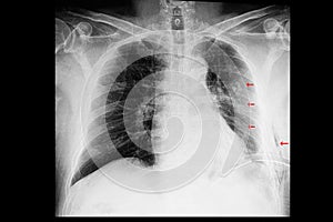 a chest xray of a patient with rib fractures and pleural effusion and subcutaneous emphysema