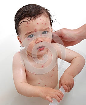 Chicken pox photo