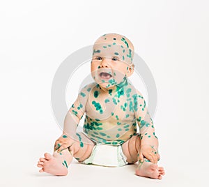 Chicken pox ailing baby on white background