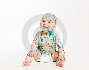 Chicken pox ailing fun infant on white background