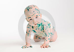 Chicken pox ailing infant photo