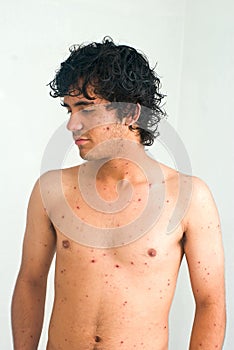Chicken pox boy