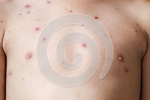 Chicken pox rash on young boy body.Chickenpox is an infection caused by the varicella zoster virus. It begins as a blister-like