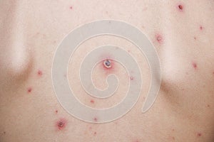 Chicken pox rash on young boy body.Chickenpox is an infection caused by the varicella zoster virus. It begins as a blister-like