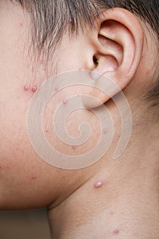 Chicken pox rash on young boy body.Chickenpox is an infection caused by the varicella zoster virus. It begins as a blister-like