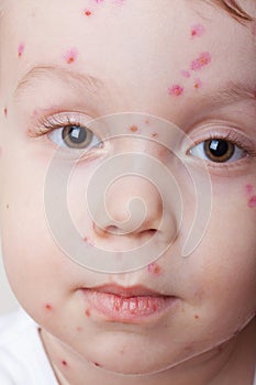 Chickenpox