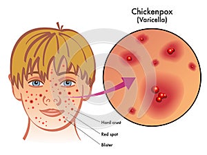 Chickenpox