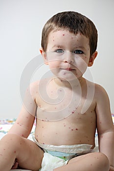 Chickenpox and baby