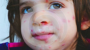 Chickenpox rash close up red dots skin condition on children face details pus