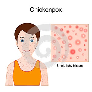 Chickenpox. Varicella. face of a child with skin rash