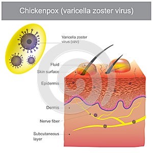 Chickenpox varicella zoster virus.