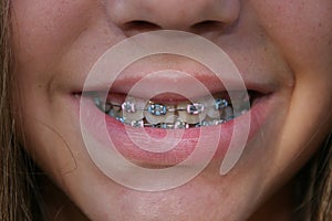 Child with braces photo