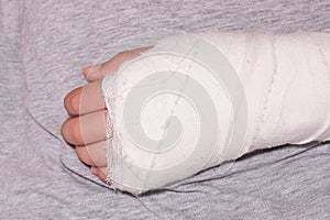 A child broken arm in plaster case, hand injury because of accident, forearm bones fracture