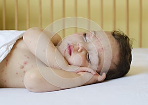 Child with chicken pox