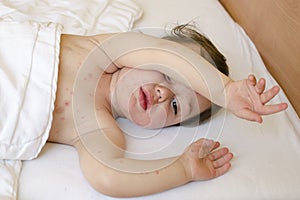 Child with chicken pox