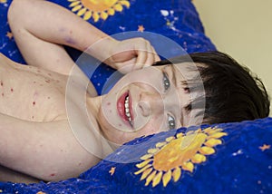 Child with chicken pox