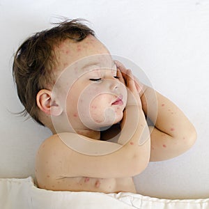 Child with chicken pox photo