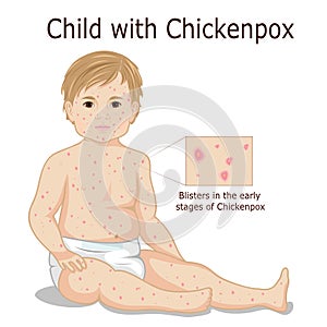 Child with Chickenpox