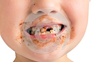 Child with a dirty mouth and missing tooth