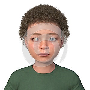 A child with esotropia, 3D illustration