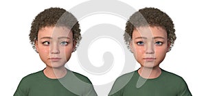 A child with esotropia and the same healthy man, 3D illustration