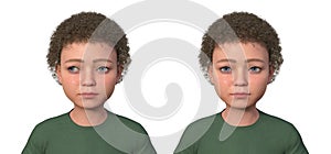 A child with exotropia and the same healthy person, 3D illustration