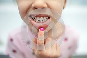 A child girl shows her mouth without one missing tooth in close-up. Lost first milk tooth