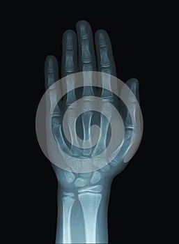 Child Hand X-Ray Unclosed Epiphysis