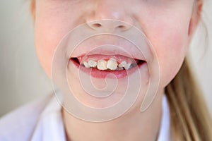 Child has crooked teeth. The concept of crowding of molars