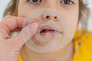 The child has stomatitis on the lip. Selective focus.