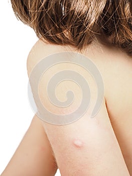 Child with hive, rash, skin abnormality towards white photo