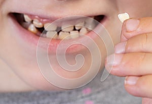 The child holds a milk tooth incisor in his hand. Extraction of milk teeth in children. Children`s dentistry. Close-up