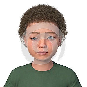 A child with hypotropia, 3D illustration