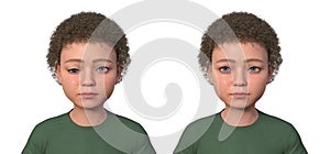 A child with hypotropia, 3D illustration