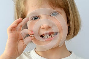 Child, kid, shows the fallen baby tooth.