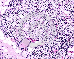 Child parathyroid gland parenchyma