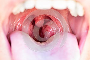 The child is a patient with large red glands. Tonsils in close-up in the mouth.