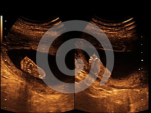 Child in the picture ultrasound