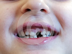 Child proud of missing front tooth