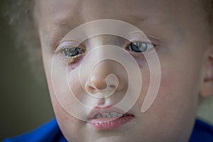 Child with purulent conjunctivitis, contagious eye infection. Symptoms and treatment concept. Close up