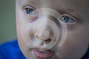 Child with purulent conjunctivitis, contagious eye infection. Symptoms and treatment concept. Close up