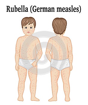 A child with rubella photo