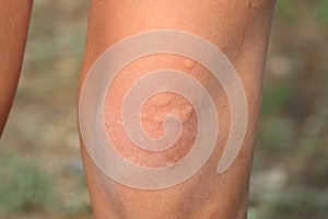 The child`s knee burned with nettle grass. Type of burn