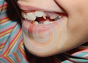 ÃÂ¡rooked teeth. photo