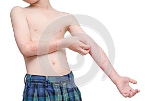Child screatching skin with rash
