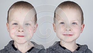 Before and after. The child shows a face with a lot of red allergic acne. The second picture shows a clean face without any