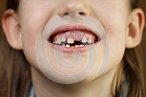 Child smiling, showing her missing milk teeth