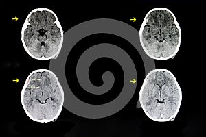 a child with subdural hematoma photo