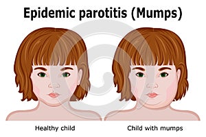 A child with symptoms of mumps